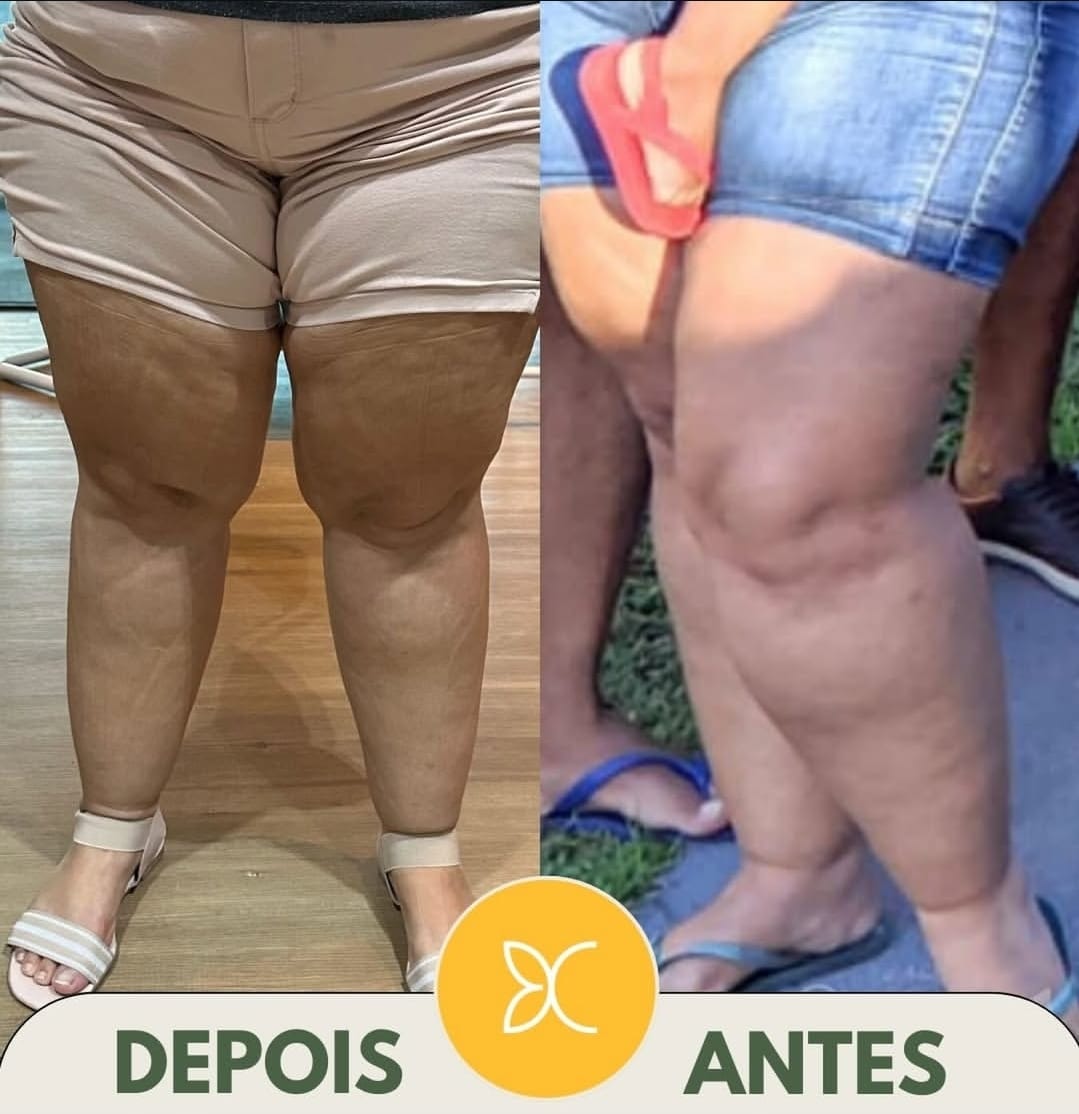 Resultado antes e depois – protocolo lipedema